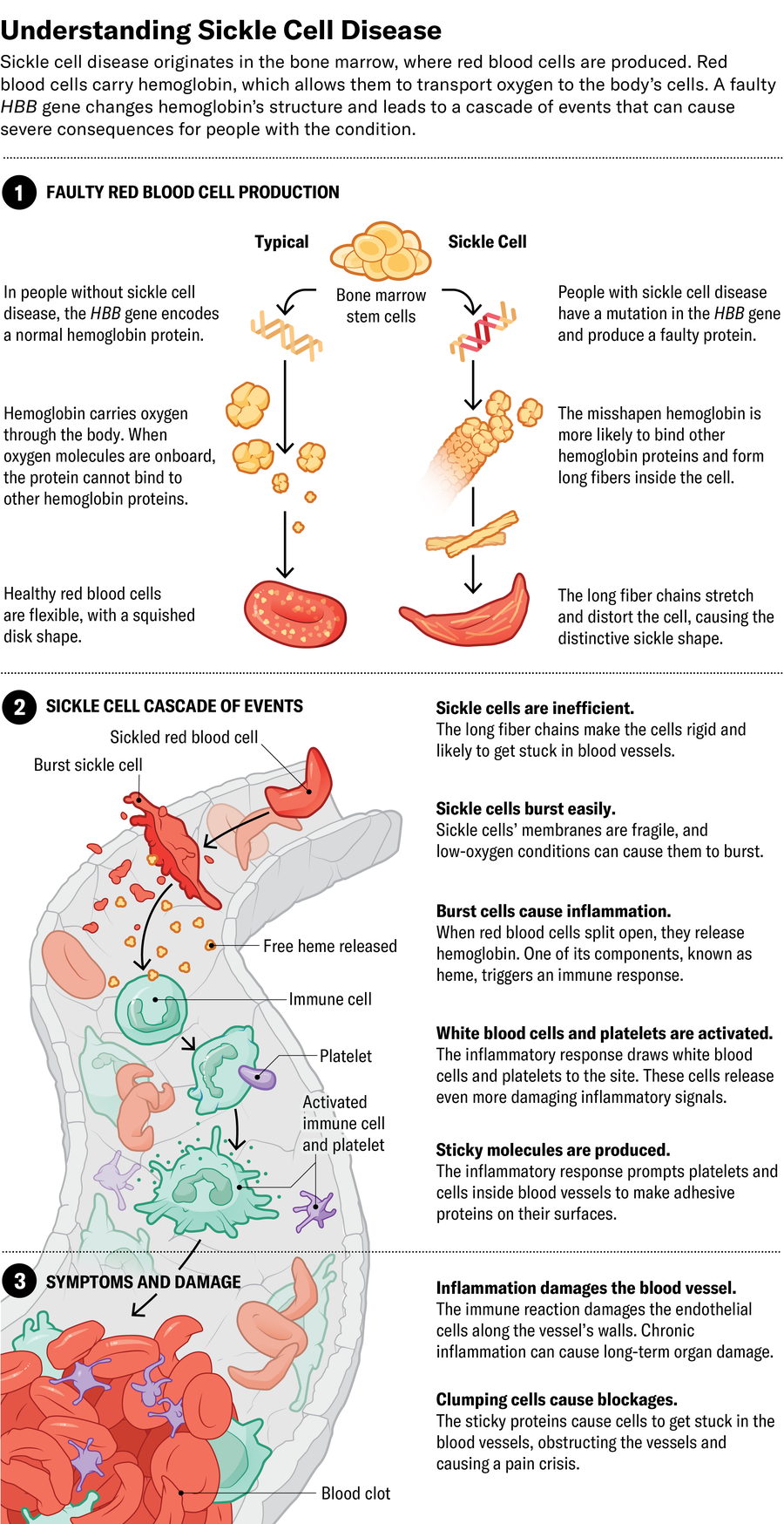Illustration shows how sickle cell disease originates in the bone marrow, where red blood cells are produced. Red blood cells carry hemoglobin, which allows them to transport oxygen to the body’s cells. A faulty HBB gene changes hemoglobin’s structure and leads to a cascade of events that can cause severe consequences for people with the condition.